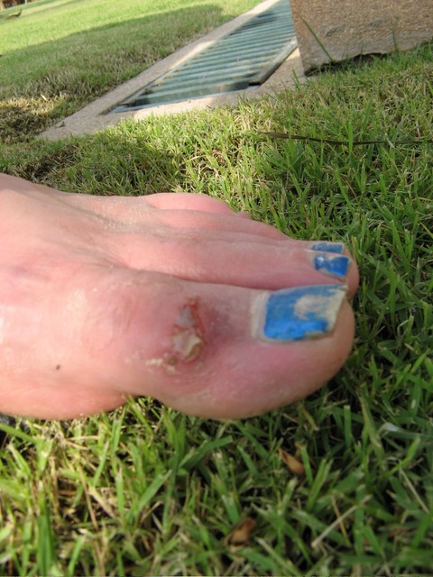 YAMJTP (Yet Another Mangled Jason Toe Picture)